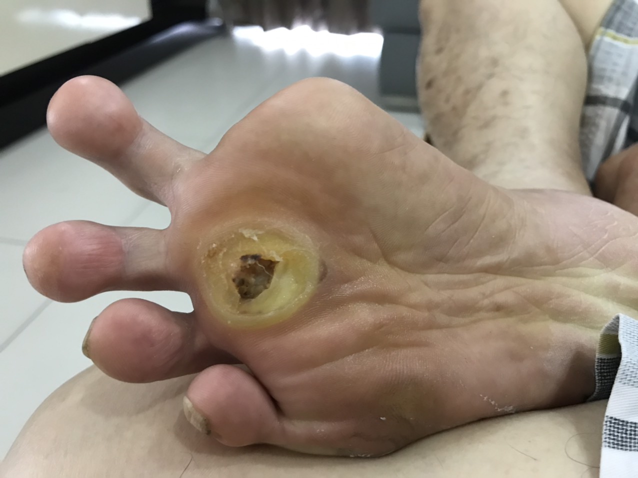 Chăm sóc bàn chân đái tháo đường